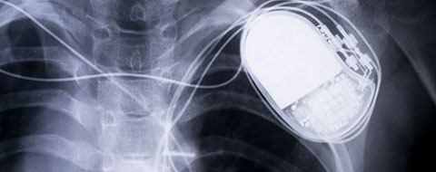 First variable rate pacemaker